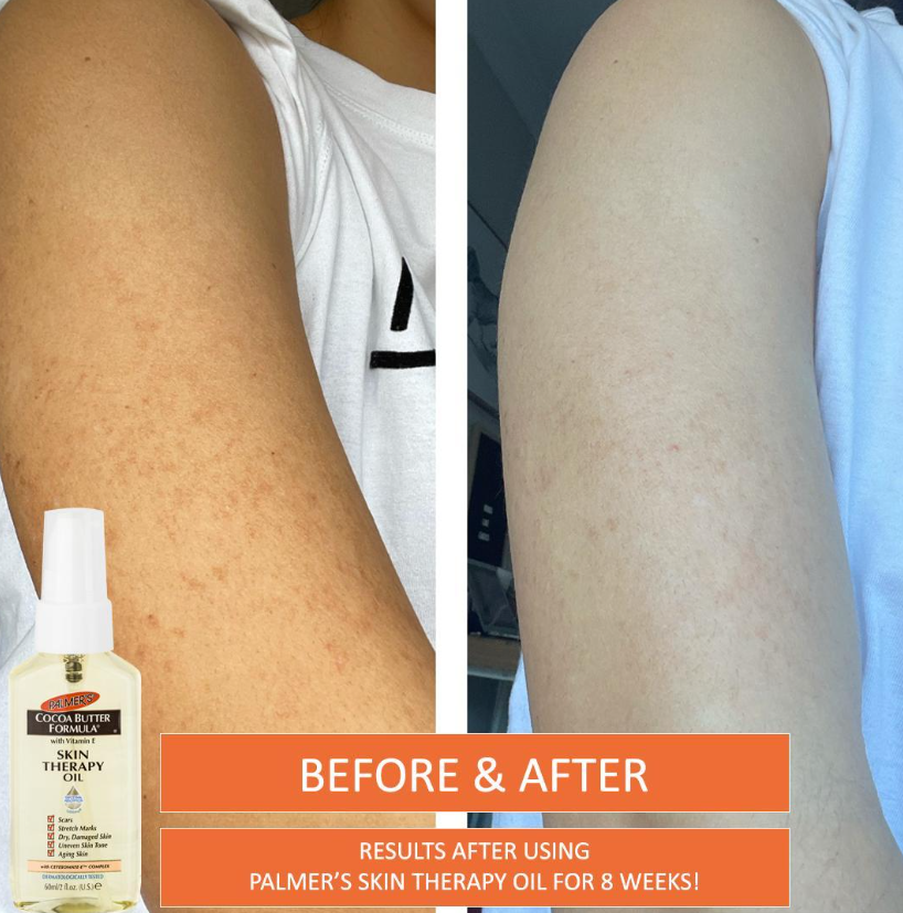skin therapy oil before and after results